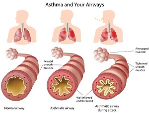 asthma-airways_lg