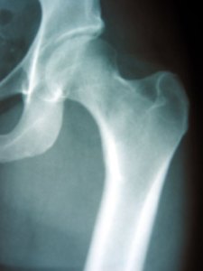 hip x-ray courtesy of http://www.orthop.washington.edu