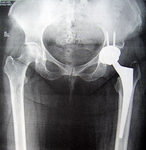 My New HIp. 14th April 2015  by Dr. Springer, OrthoCarolina