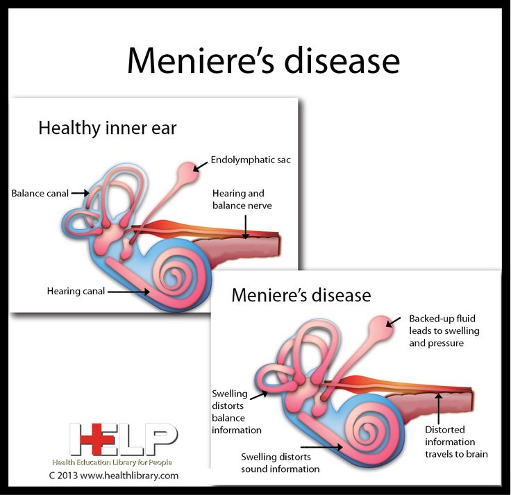 menieres-ear