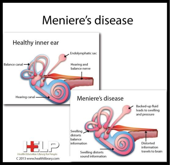 menieres-ear